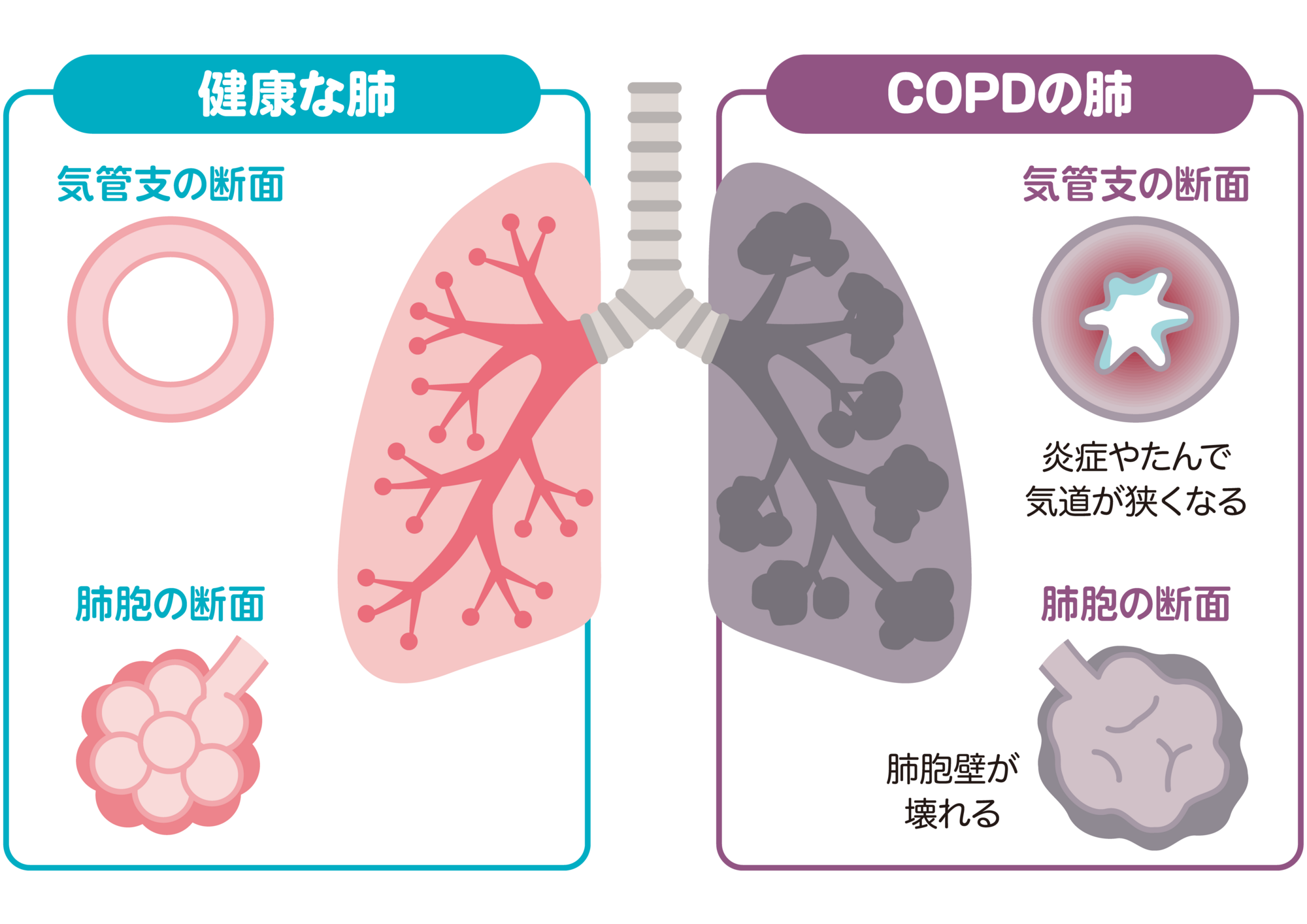 COPDとは？