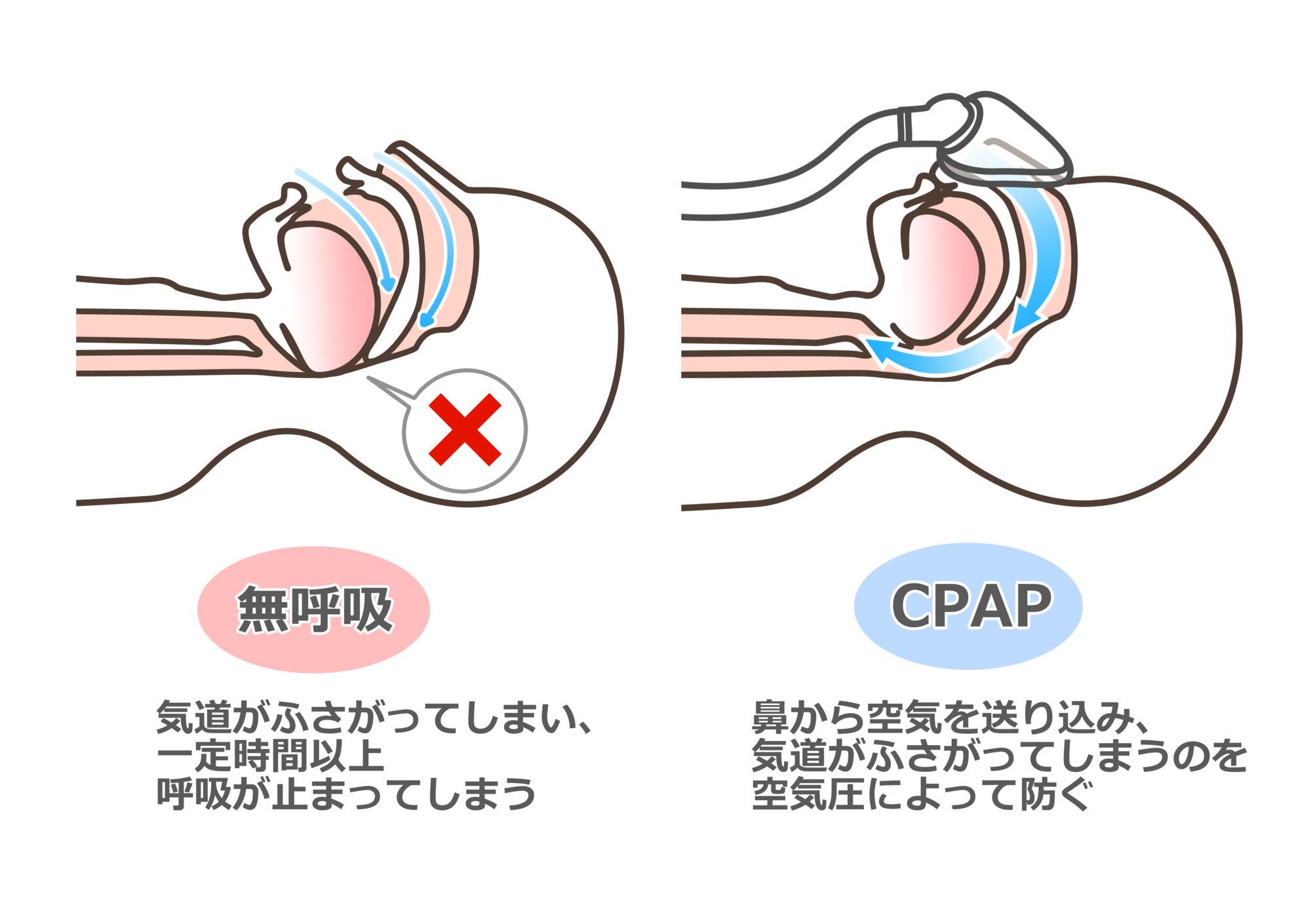 CPAP（シーパップ）治療