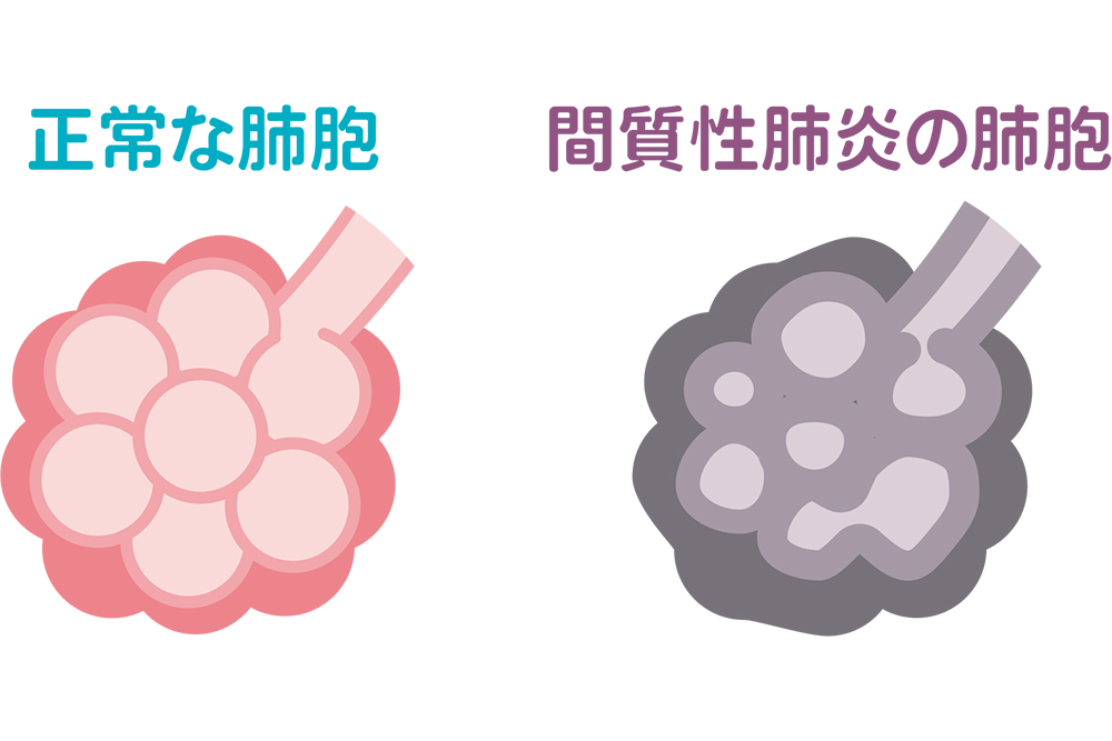間質性肺炎とは?
