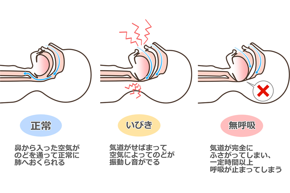 無呼吸は何秒から危険？